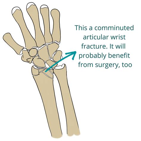 This is the American ICD-10-CM version of T81. . Icd 10 left wrist fracture